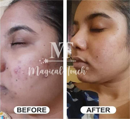 HYDRA GLOW ANTI ACNE COMBO (FOR ACNE FREE & GLOWING SKIN)