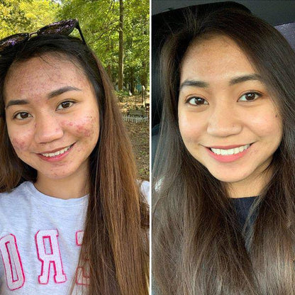 HYDRA GLOW ANTI ACNE COMBO (FOR ACNE FREE & GLOWING SKIN)